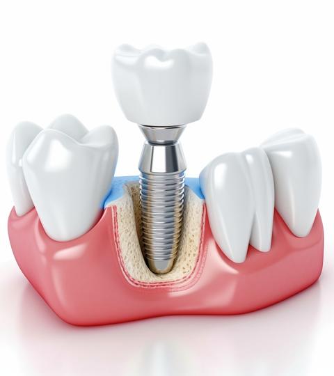 Имплантация зубов цена отзывы